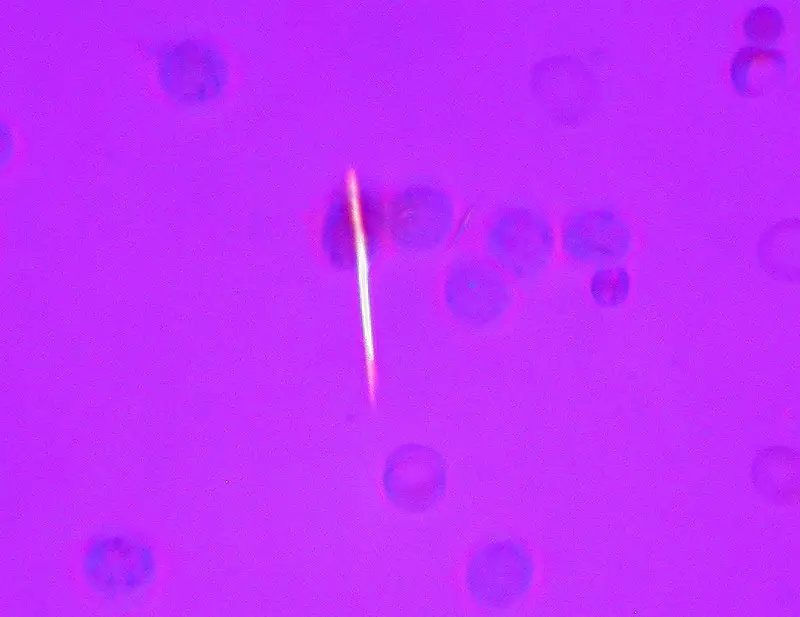 Gout monosodium urate crystals in joint fluid