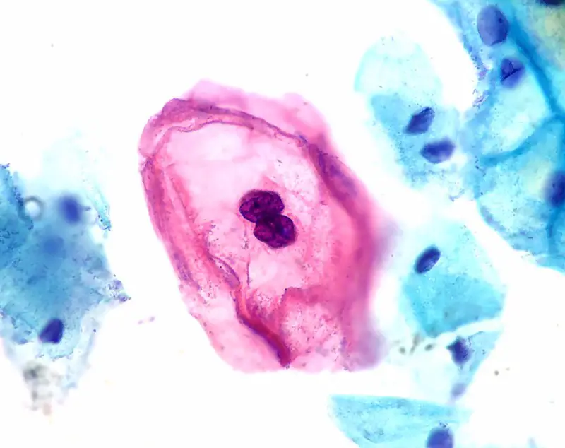 HPV-Infected Squamous Cell (Koilocyte) of the Cervix