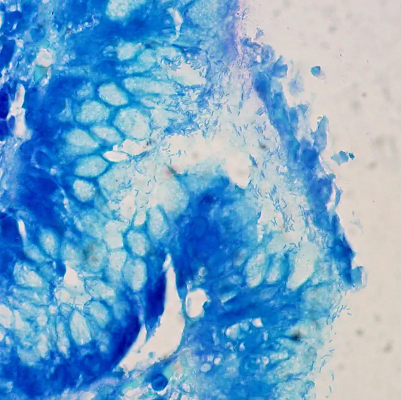 Helicobacter Pylori, Stomach Biopsy, Giemsa Stain
