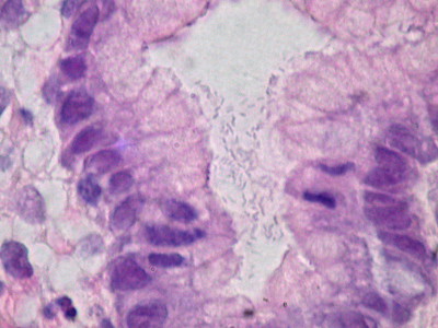 Helicobacter pylori, Gastric Mucosa, H&E