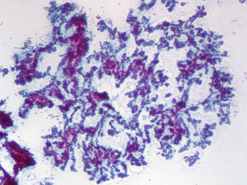 Hepatocellular Carcinoma, FNA