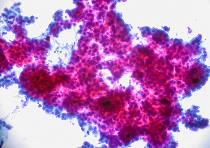 Hepatocellular Carcinoma, FNA