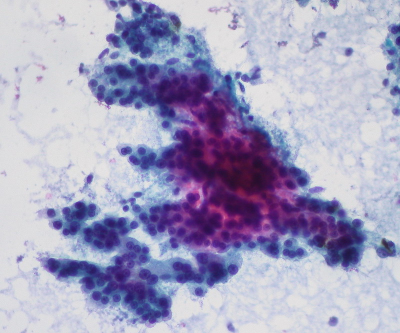 Hepatocellular Carcinoma, FNA