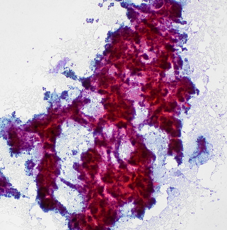 Hepatocellular Carcinoma, FNA