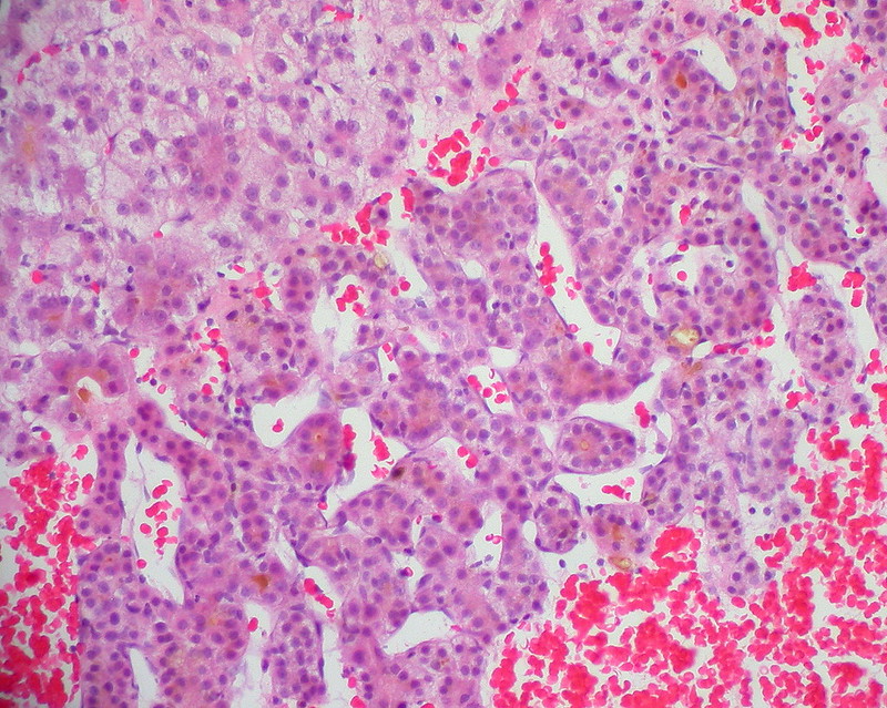 Hepatocellular Carcinoma, FNA Clot Section