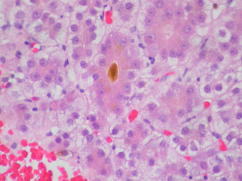 Hepatocellular Carcinoma, FNA Clot Section