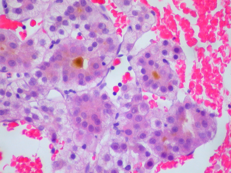 Hepatocellular Carcinoma, FNA Clot Section
