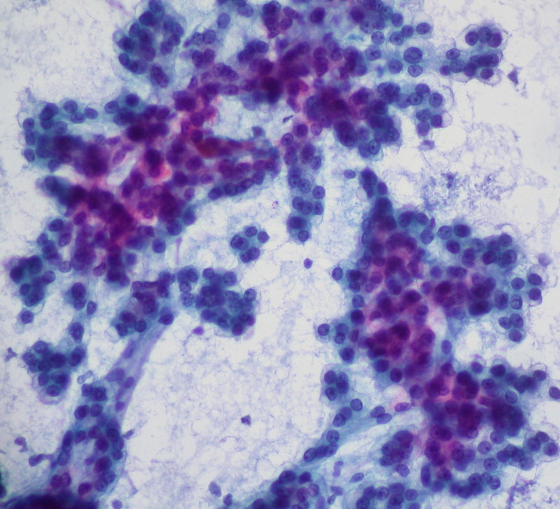 Hepatocellular Carcinoma, FNA