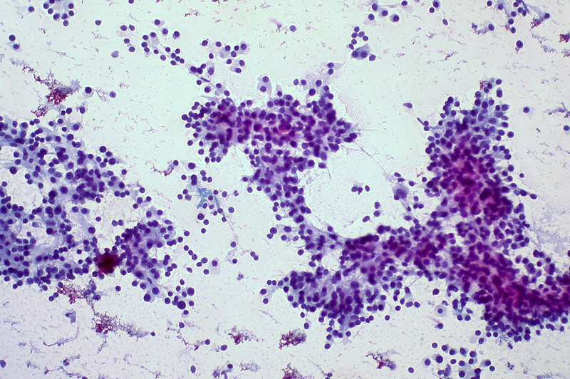 Hepatocellular Carcinoma, Liver FNA