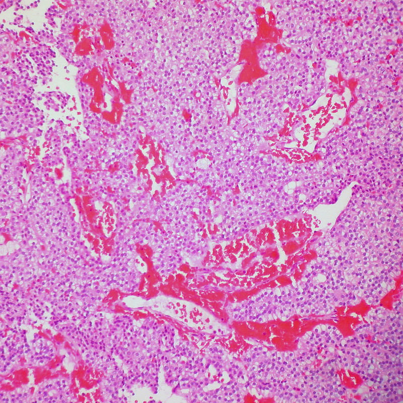 Hepatocellular Carcinoma, Liver FNA