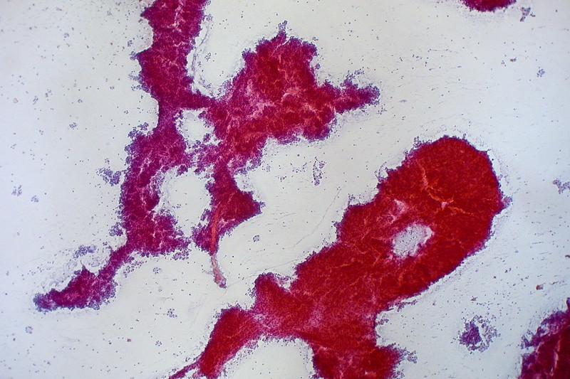 Hepatocellular Carcinoma, Liver FNA