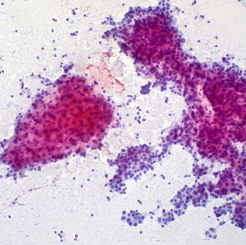 Hepatocellular Carcinoma, Liver FNA