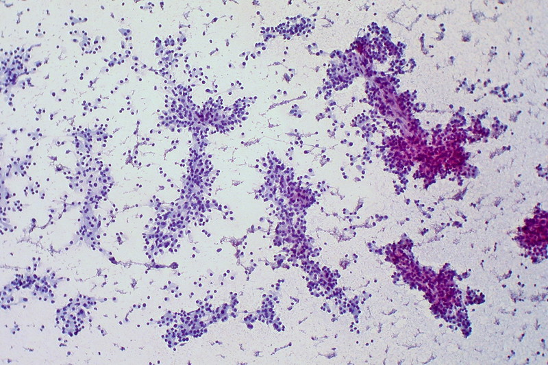 Hepatocellular Carcinoma, Liver FNA
