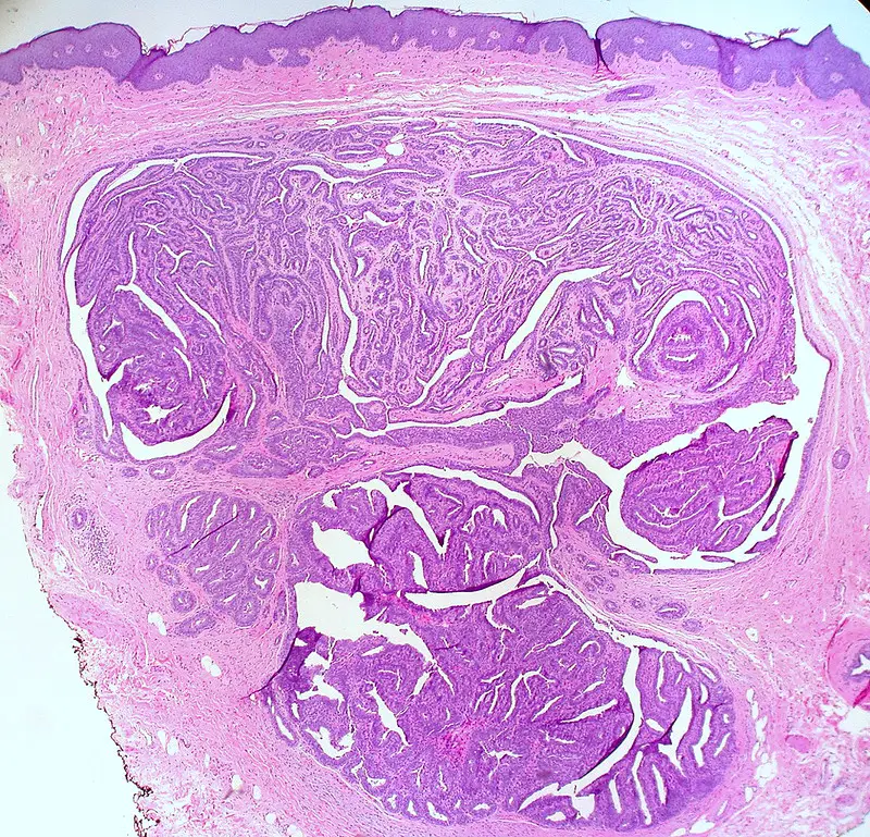 Hidradenoma Papilliferum of the Vulva