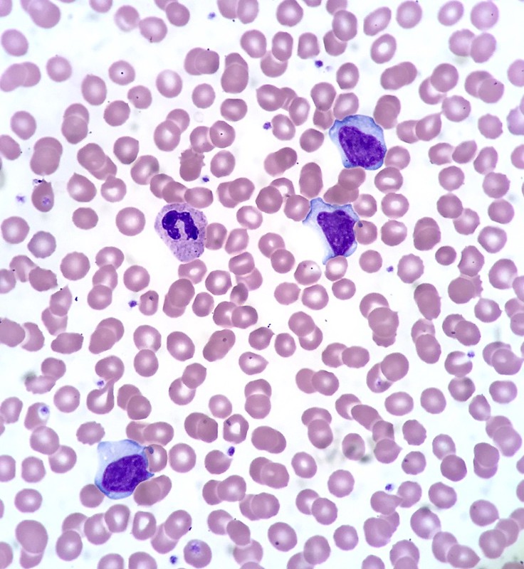 Infectious Mononucleosis. Peripheral Blood, Wright Stain