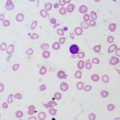Iron-deficiency Anemia, Peripheral Blood Smear