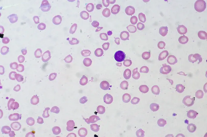 Iron-deficiency Anemia, Peripheral Blood Smear