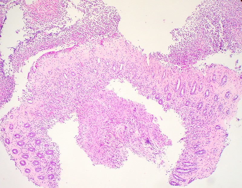 Ischemic Colitis