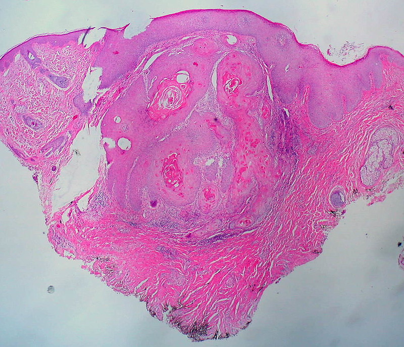Keratoacanthoma