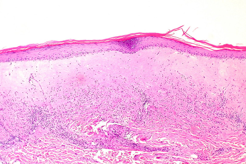 Lichen Sclerosus, Atrophic