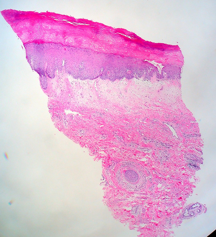 Lichen Sclerosus, Hypertrophic