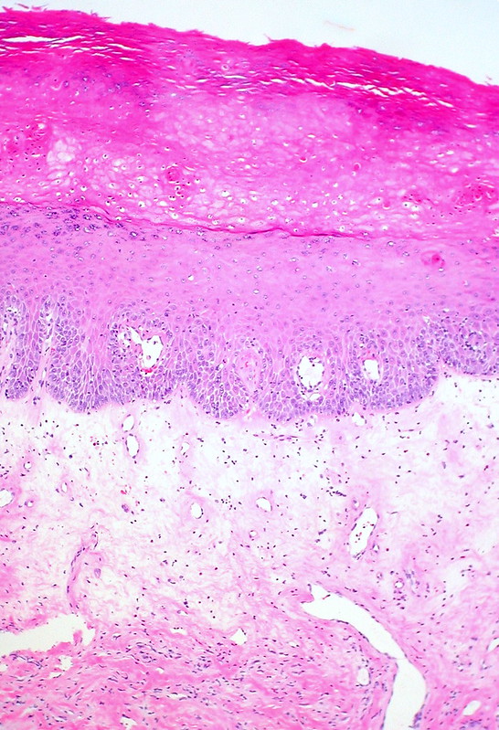 Lichen Sclerosus, Hypertrophic