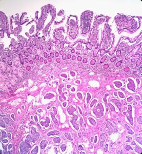 Low-Grade Neuroendocrine (Carcinoid) Tumor of the Small Intestine