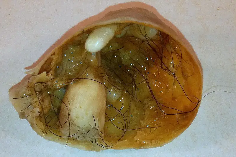 Mature Cystic Teratoma of the Ovary
