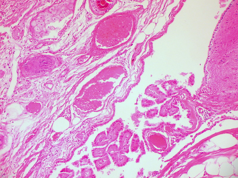 Mature Cystic Teratoma of the Ovary