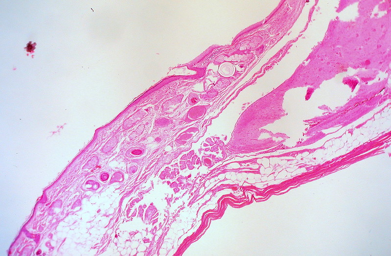 Mature Cystic Teratoma of the Ovary