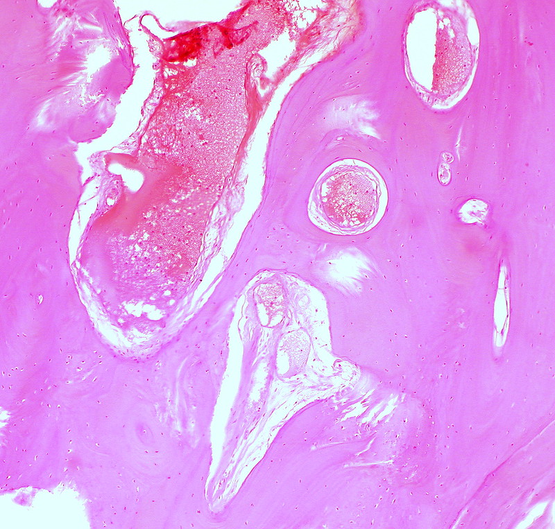Mature Cystic Teratoma of the Ovary Bone Tissue