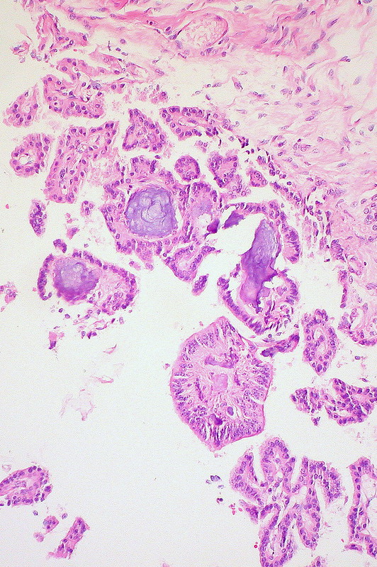 Mature Cystic Teratoma of the Ovary Choroid Plexus with Psammoma Bodies