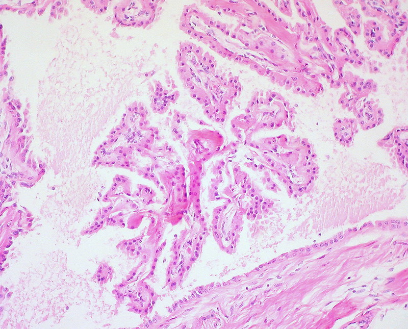 Mature Cystic Teratoma of the Ovary Choroid Plexus