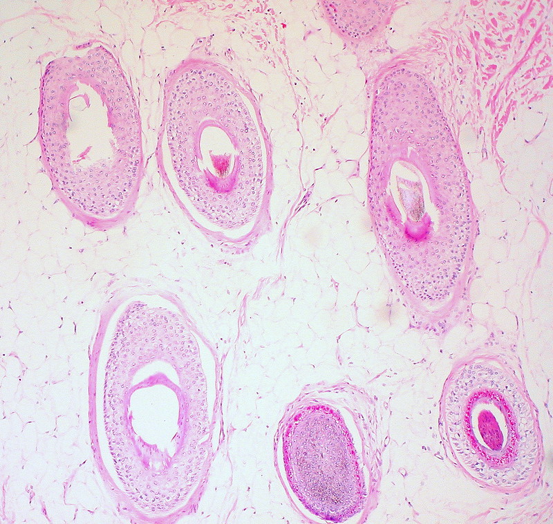 Mature Cystic Teratoma of the Ovary Hair Follicles