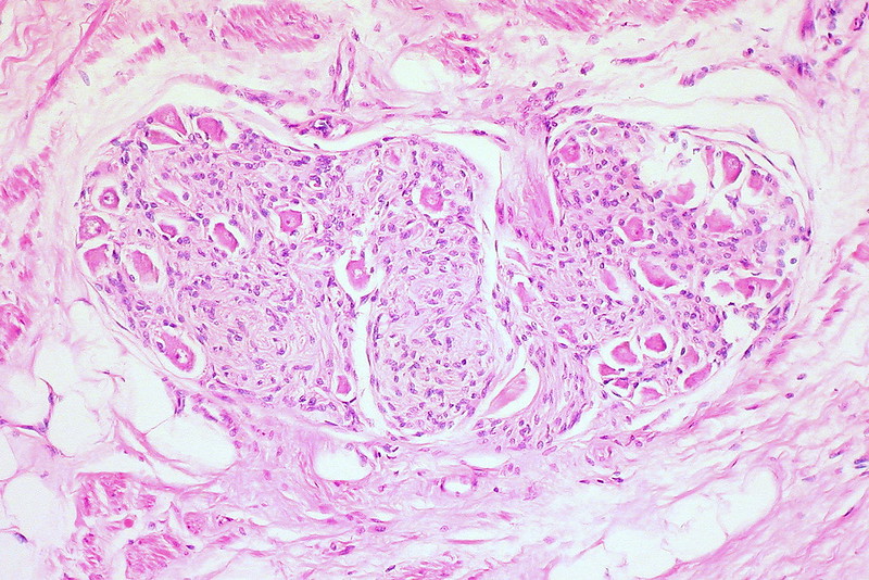 Mature Cystic Teratoma of the Ovary Neural Ganglion