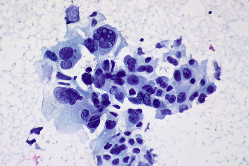 Non-small Cell Carcinoma of the Lung, FNA