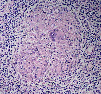 Noncaseating Granuloma