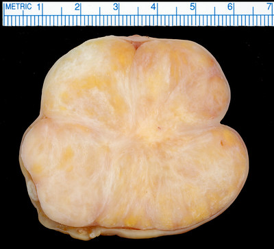 Ovarian Fibroma
