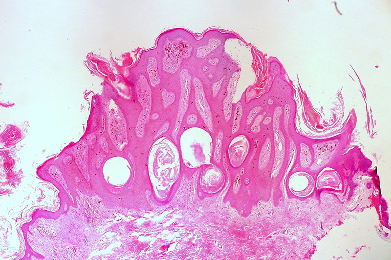 Pigmented Seborrehic Keratosis of the Vulva