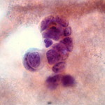 Small Cell Carcinoma, Pleural Fluid Cytology