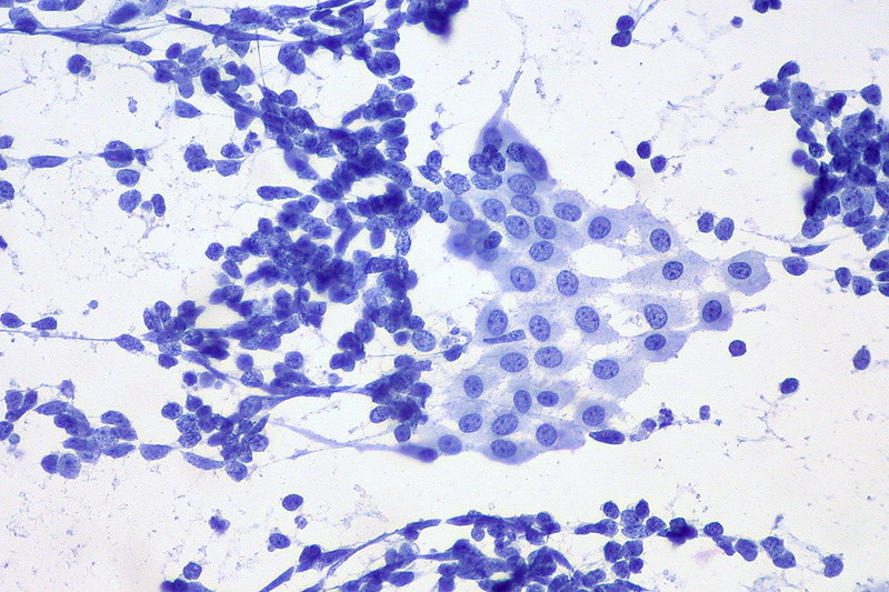 Small cell lung carcinoma vs. benign mesothelial cells