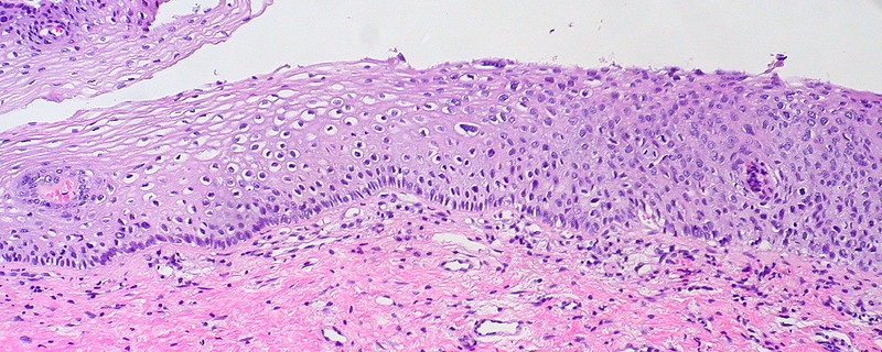 Spectrum of SILCervical Dysplasia