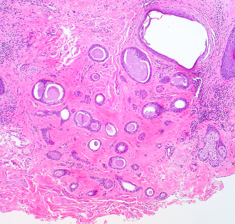 Syringoma and Lichen Sclerosus, Vulva