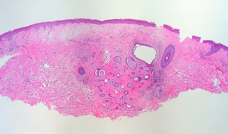 Syringoma and Lichen Sclerosus, Vulva