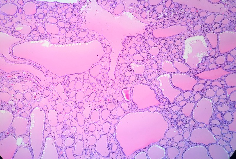 Thyroid Gland Multinodular Goiter