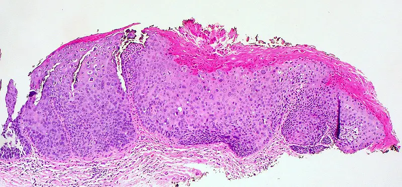 Vulvar Intraepithelial Neoplasia, Grade 3 (VIN 3)