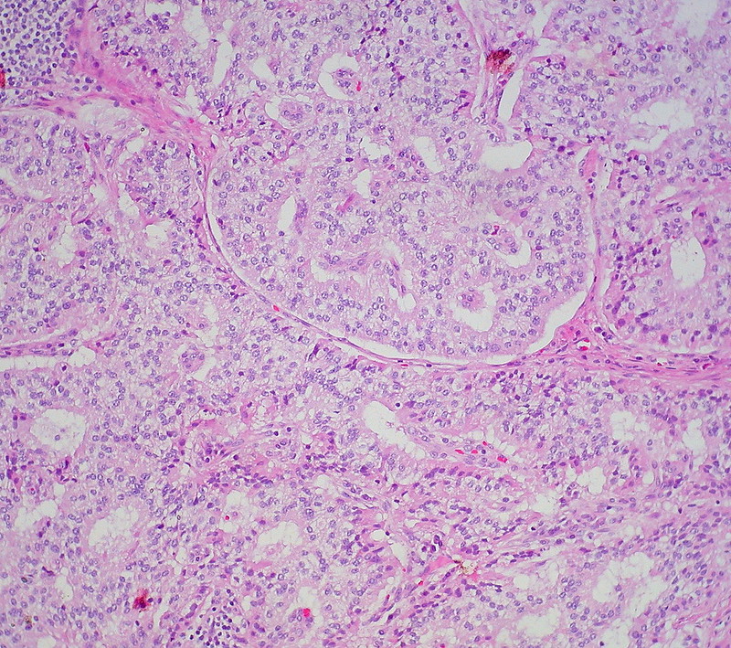 Well-differentiated neuroendocrine tumor of the duodenum