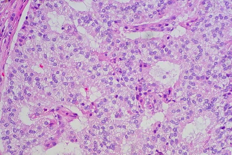 Well-differentiated neuroendocrine tumor of the duodenum