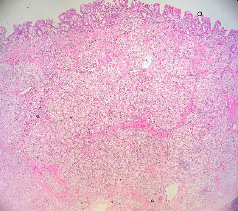 Well-differentiated neuroendocrine tumor of the duodenum