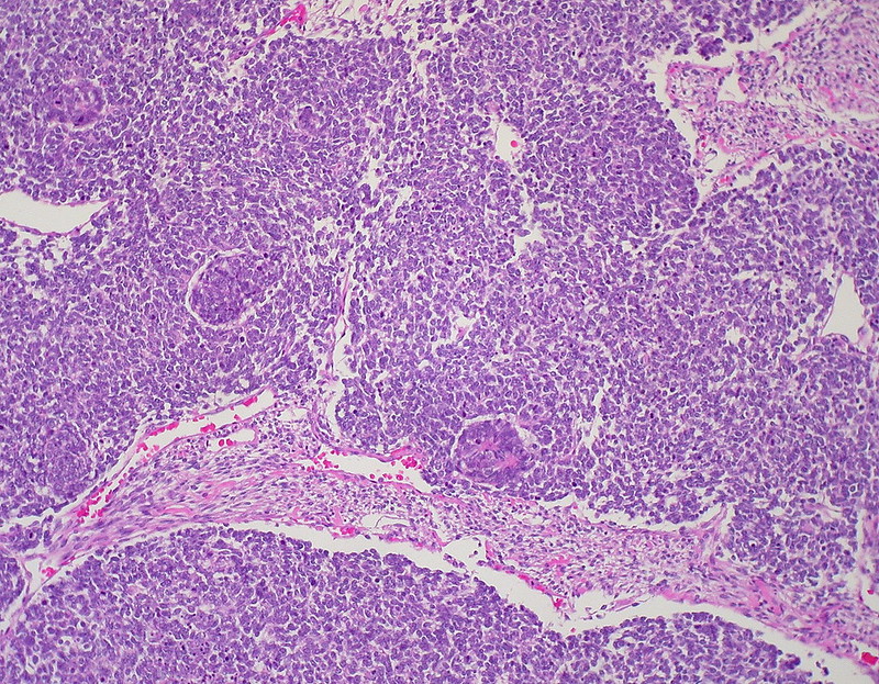 Wilm’s Tumor (Nephroblastoma)
